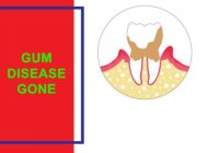 Gum Disease Gone e-cover